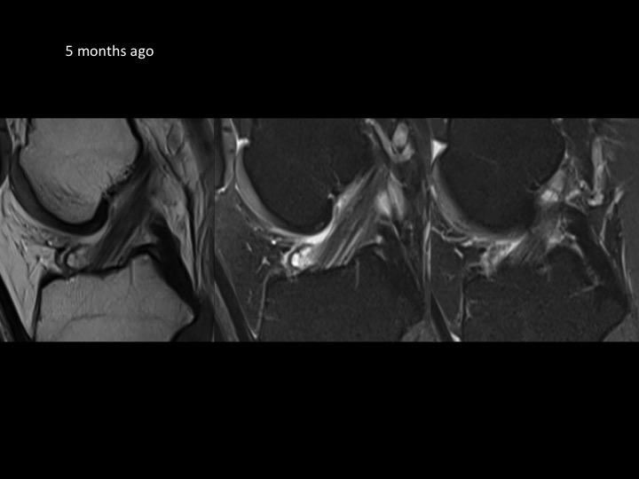 Figure 4 for case anterior cruciate ligament ( RID2781 )